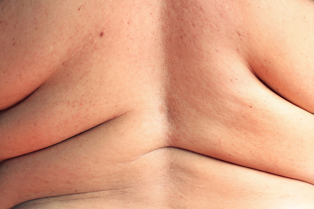 Get Rid of Back Fat With Diet and Exercise